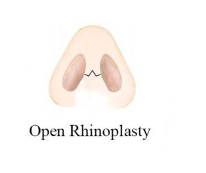 open rhinoplasty in Hyderabad